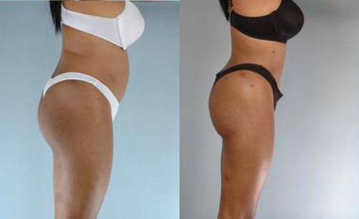 Before & After Liposuction Case 3615 View 3 View in Houston, TX