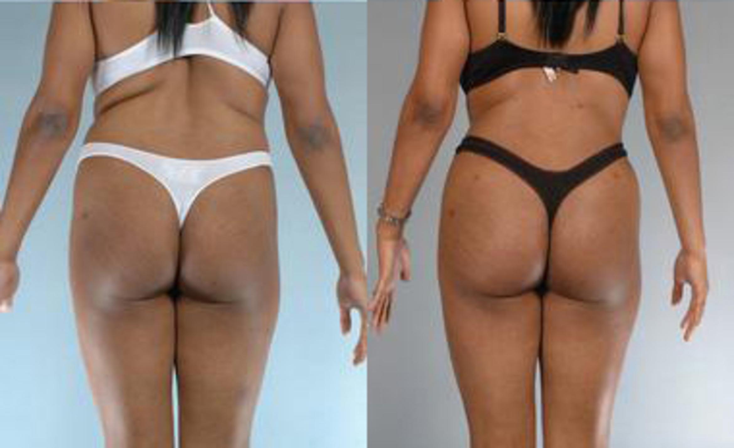 Before & After Liposuction Case 3615 View 4 View in Houston, TX