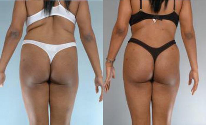 Before & After Liposuction Case 3615 View 4 View in Houston, TX