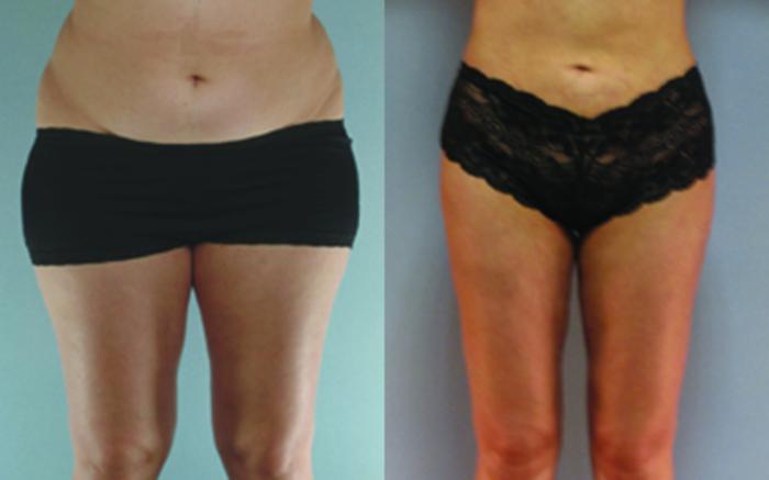 Before & After Liposuction Case 3625 View 1 View in Houston, TX