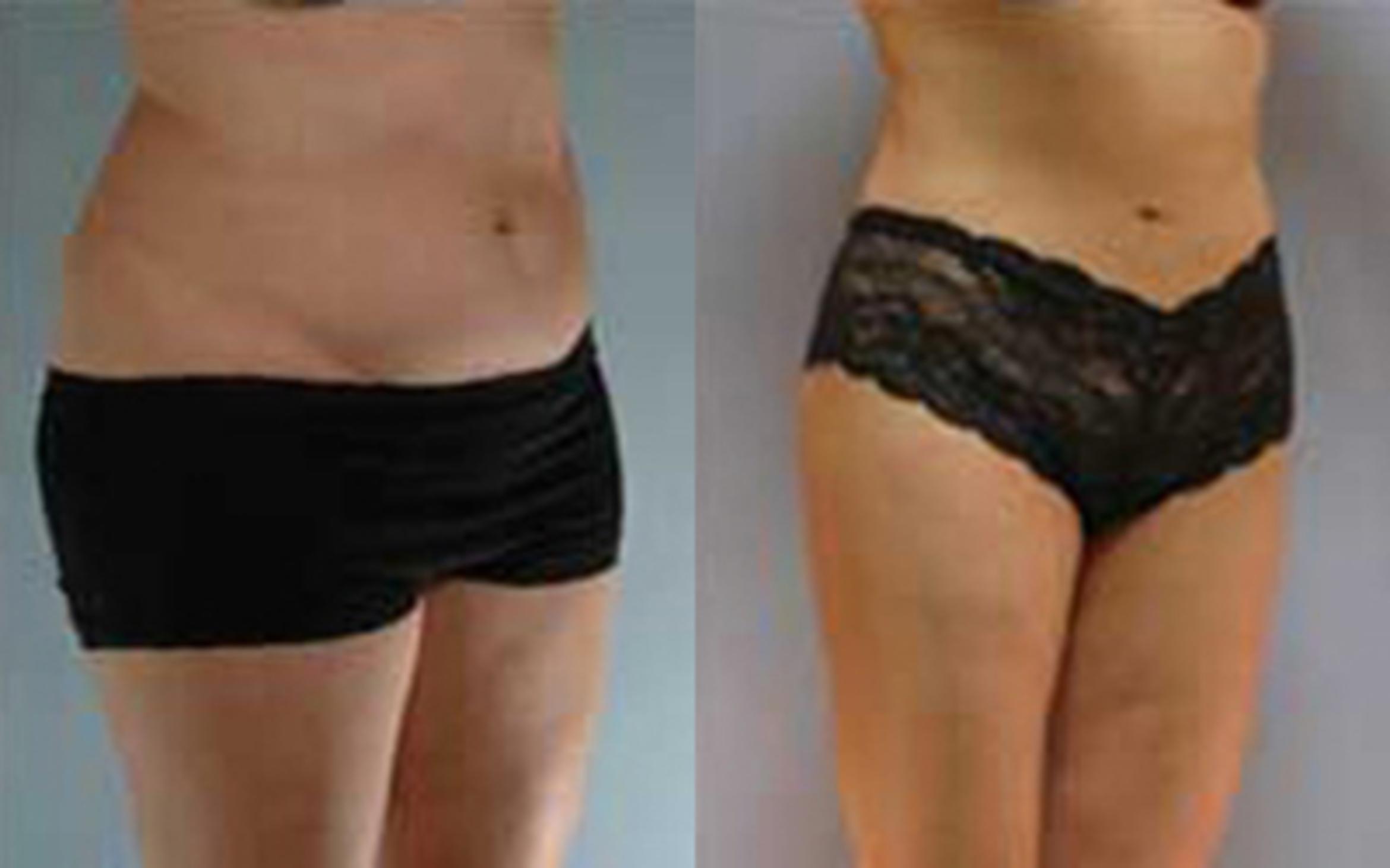 Before & After Liposuction Case 3625 View 2 View in Houston, TX