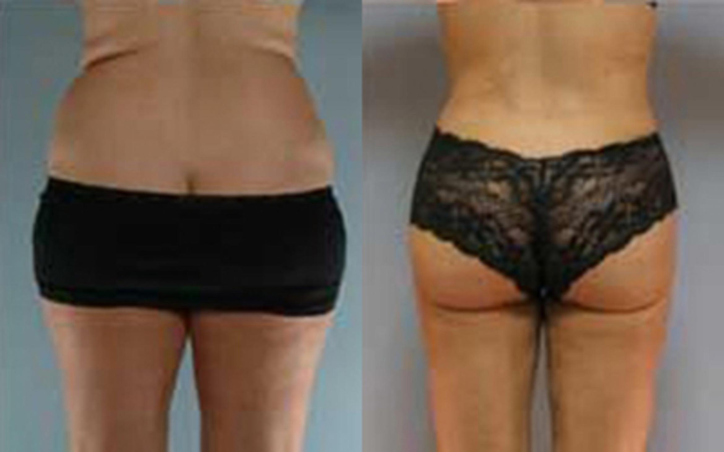 Before & After Liposuction Case 3625 View 3 View in Houston, TX