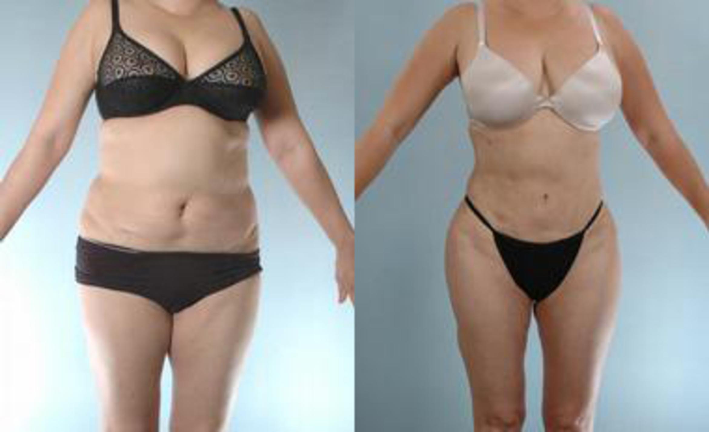 Before & After Liposuction Case 3633 View 1 View in Houston, TX