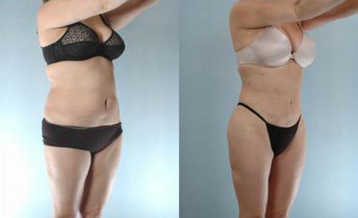 Before & After Liposuction Case 3633 View 2 View in Houston, TX