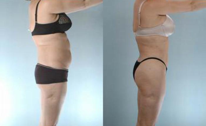 Before & After Liposuction Case 3633 View 3 View in Houston, TX