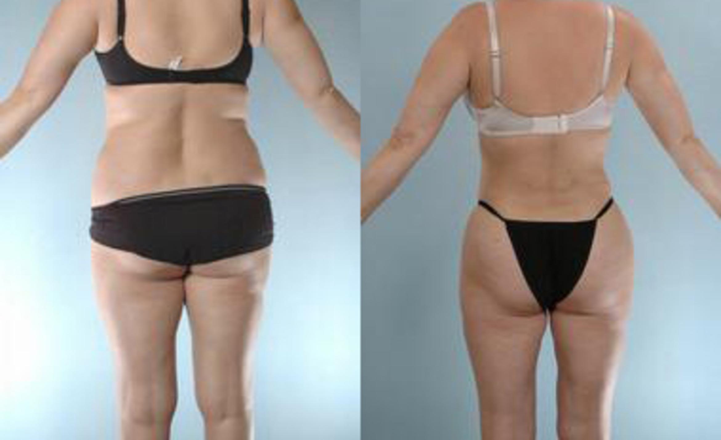 Before & After Liposuction Case 3633 View 4 View in Houston, TX