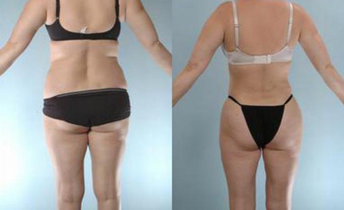 Before & After Liposuction Case 3633 View 4 View in Houston, TX