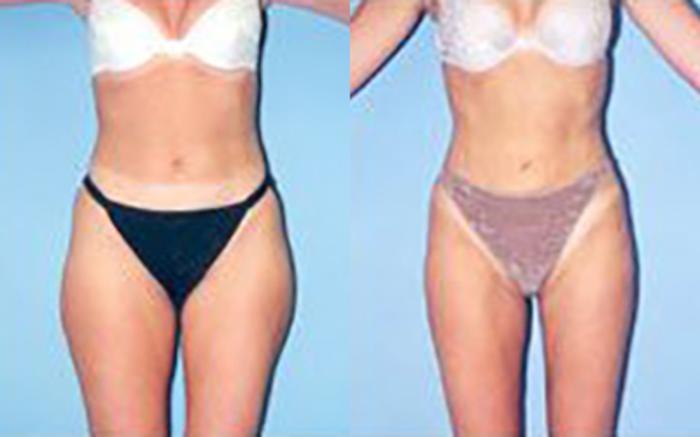 Before & After Liposuction Case 3643 View 1 View in Houston, TX