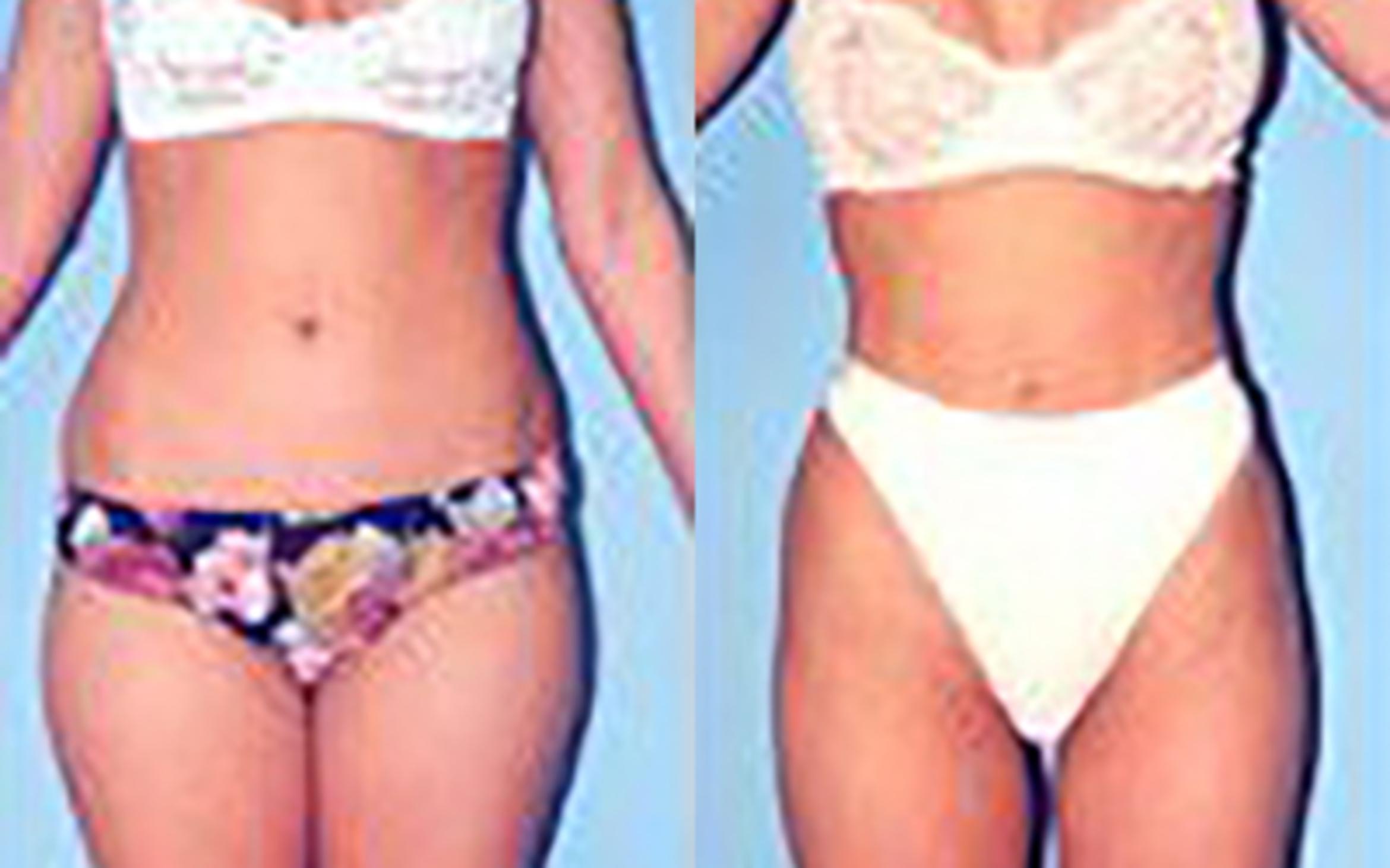 Before & After Liposuction Case 3647 View 1 View in Houston, TX