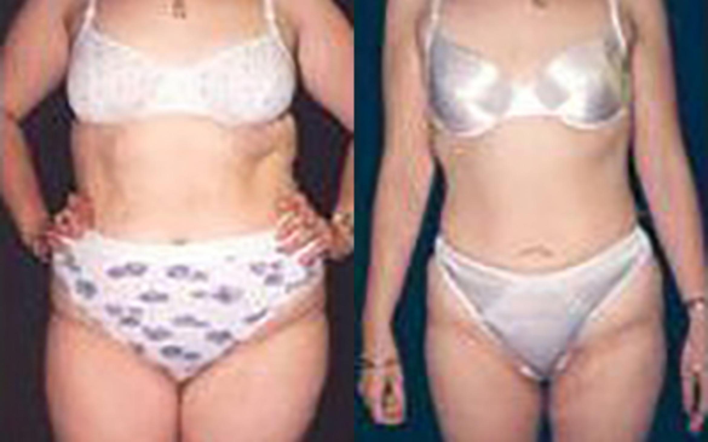 Before & After Liposuction Case 3651 View 1 View in Houston, TX