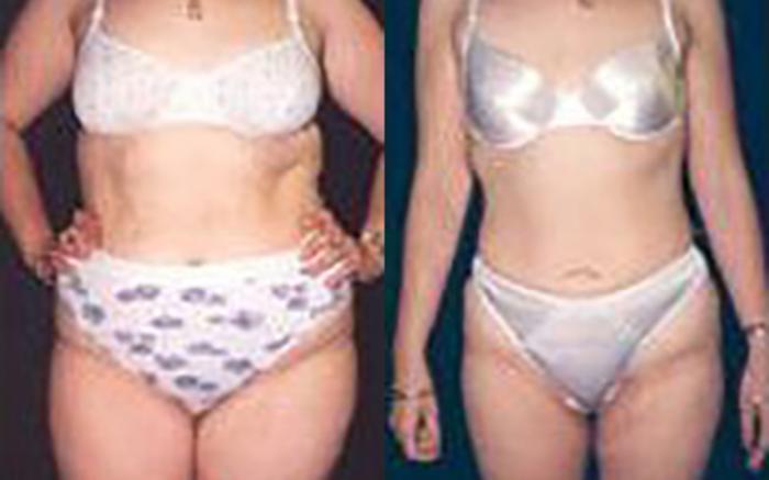 Before & After Liposuction Case 3651 View 1 View in Houston, TX