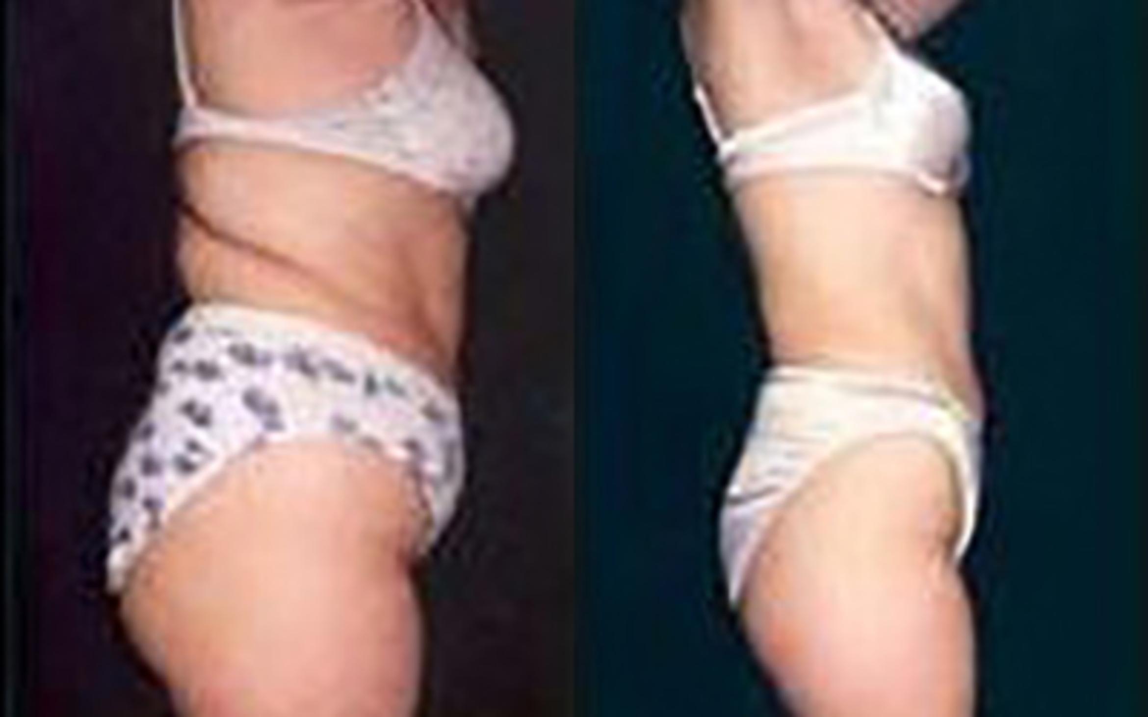 Before & After Liposuction Case 3651 View 2 View in Houston, TX