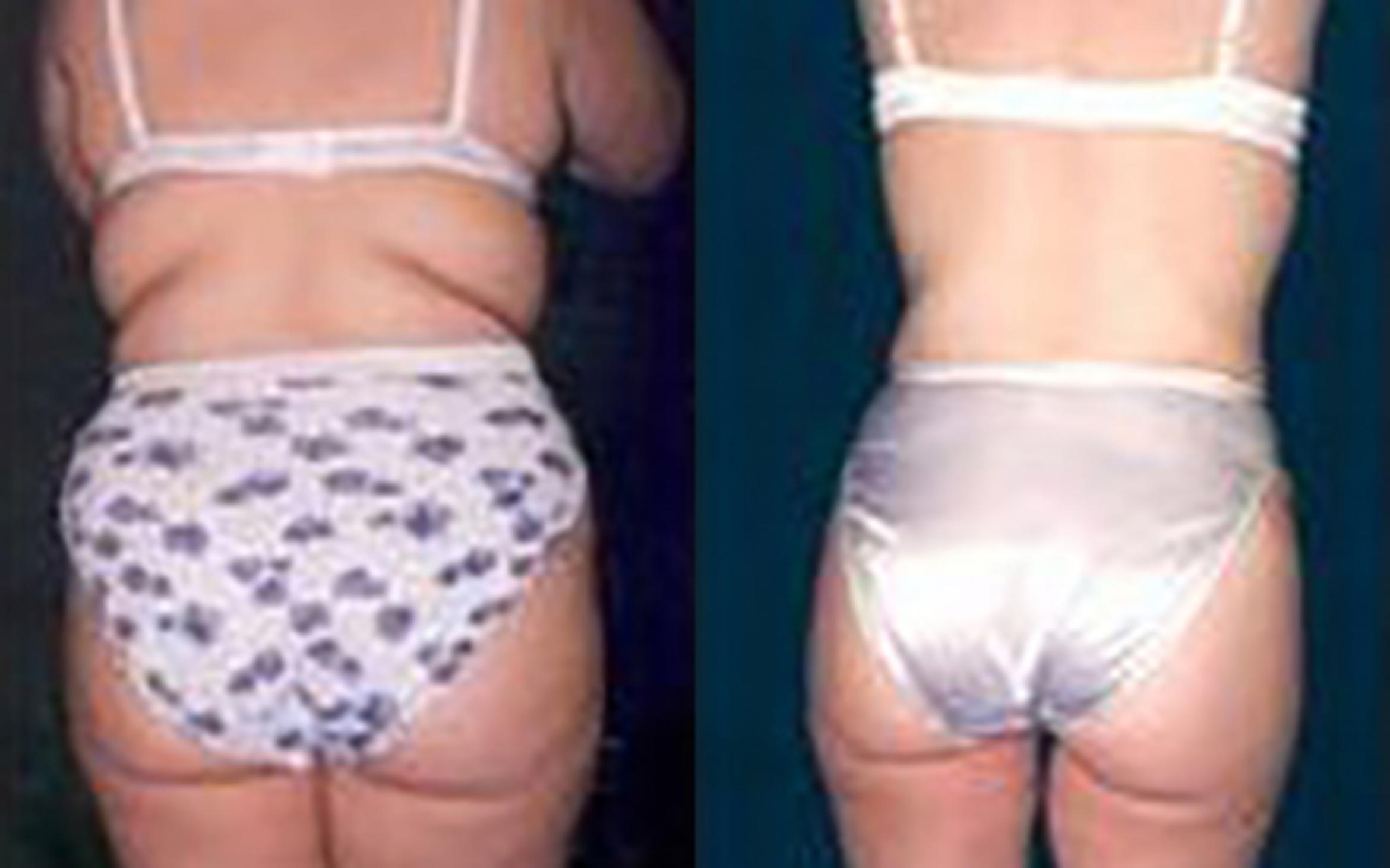Before & After Liposuction Case 3651 View 3 View in Houston, TX
