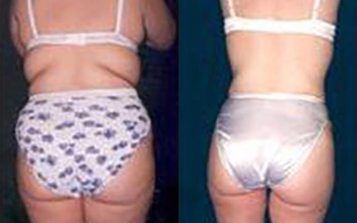 Before & After Liposuction Case 3651 View 3 View in Houston, TX