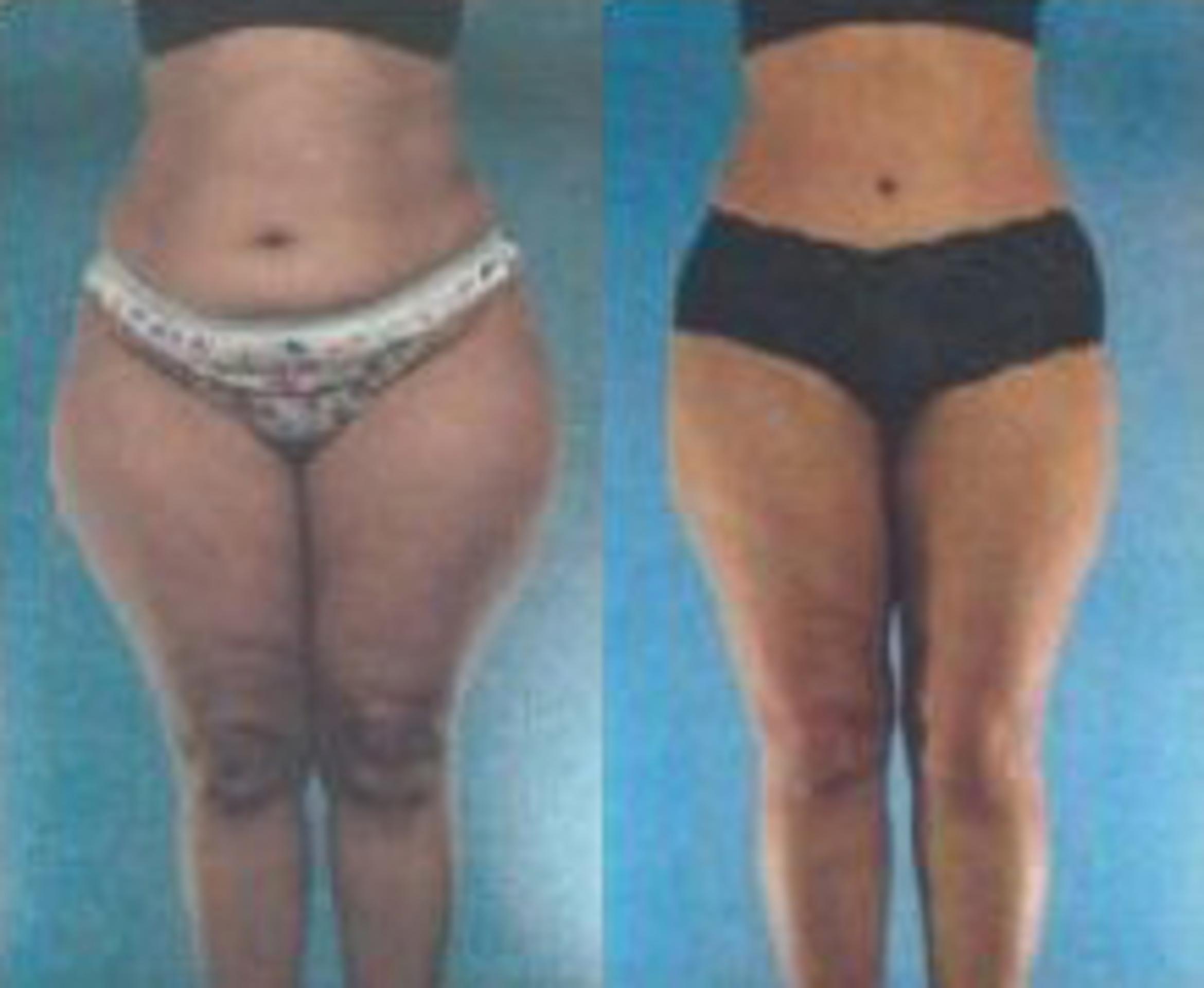 Before & After Liposuction Case 3659 View 1 View in Houston, TX
