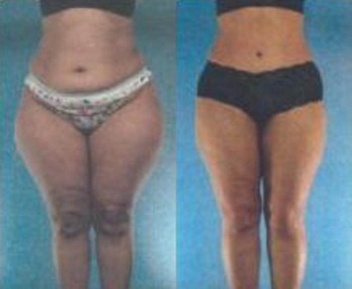 Before & After Liposuction Case 3659 View 1 View in Houston, TX