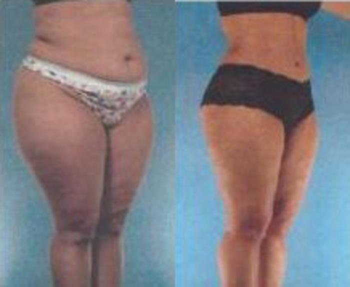 Before & After Liposuction Case 3659 View 2 View in Houston, TX