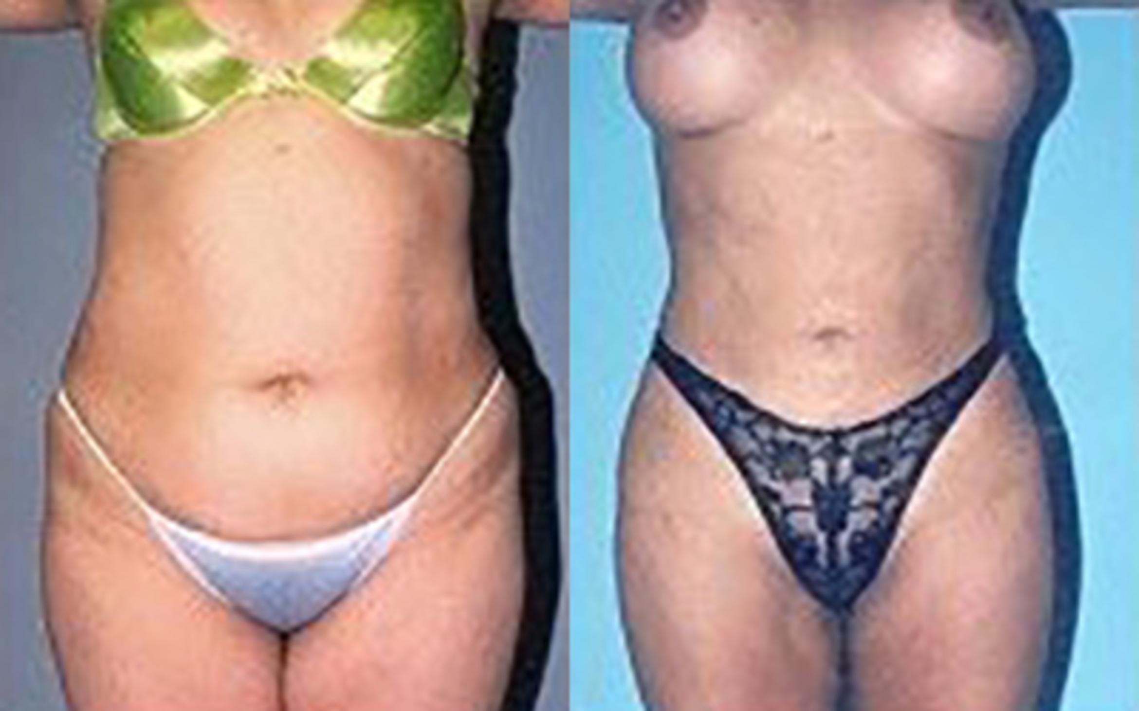 Before & After Liposuction Case 3667 View 1 View in Houston, TX