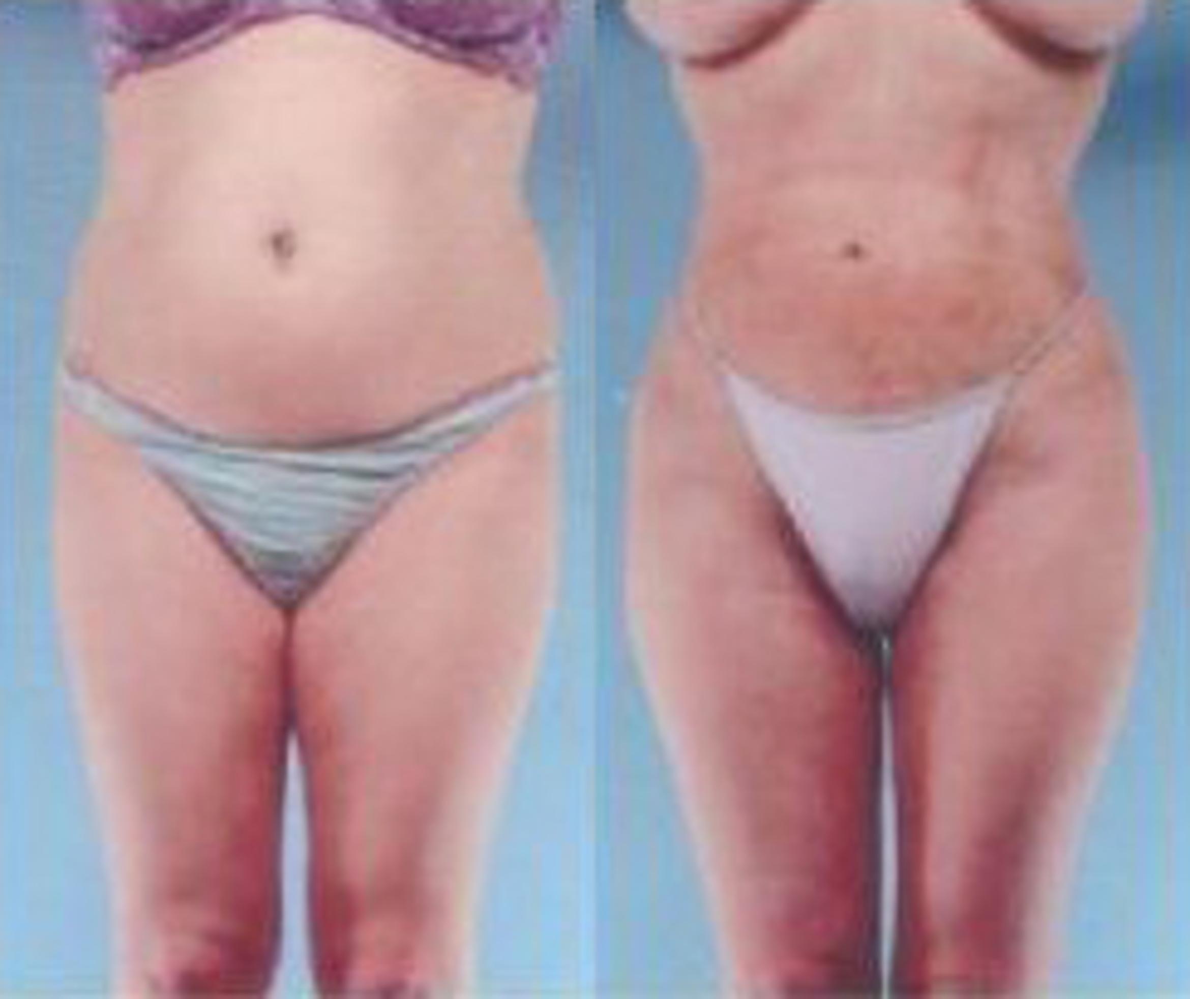 Before & After Liposuction Case 3671 View 1 View in Houston, TX