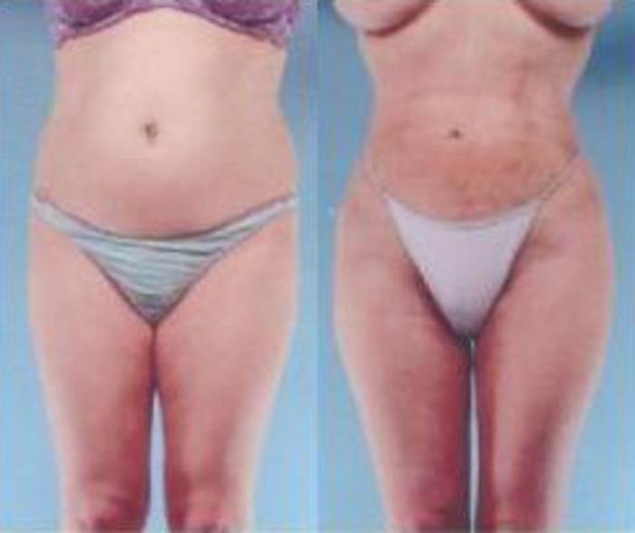 Before & After Liposuction Case 3671 View 1 View in Houston, TX