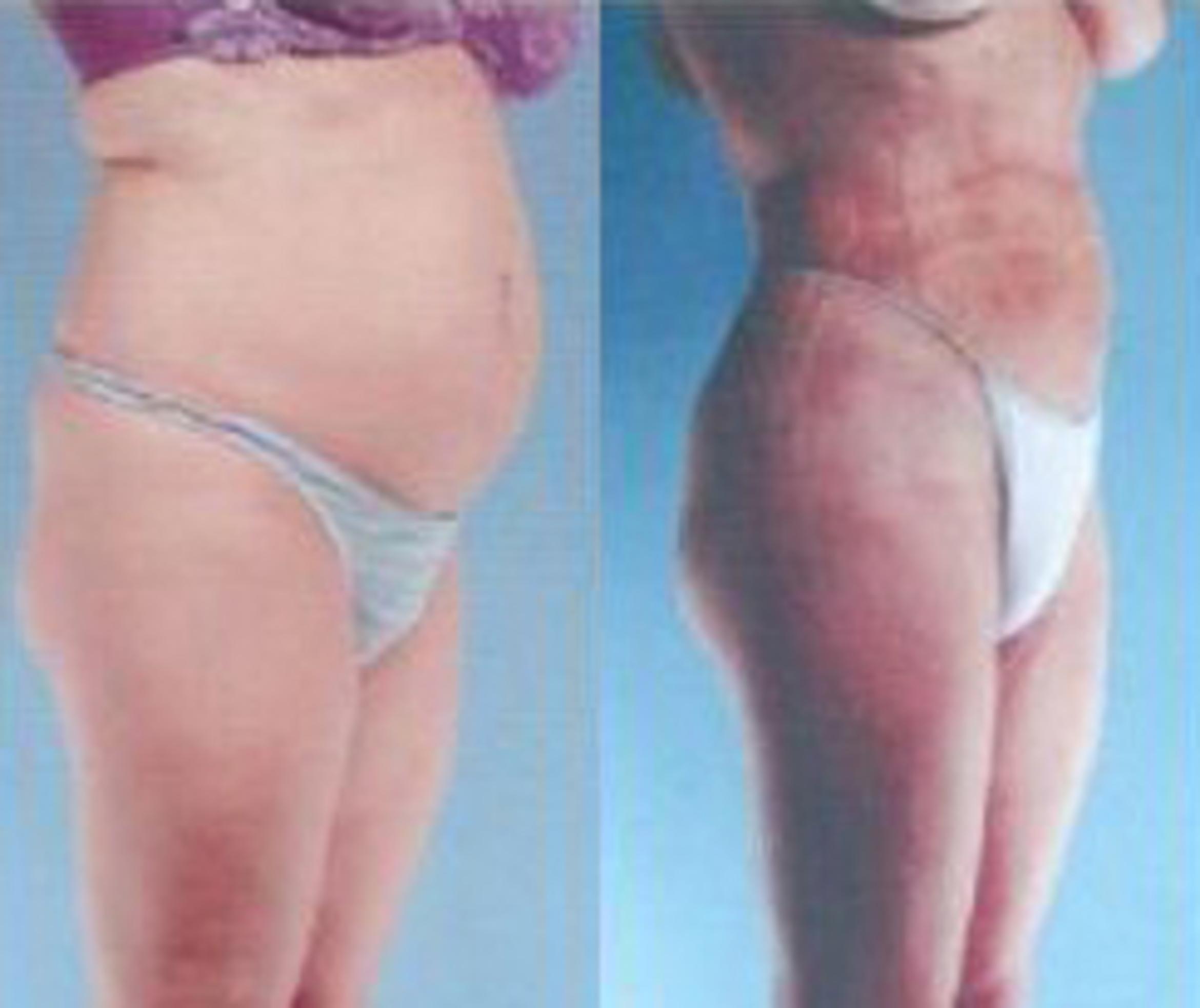Before & After Liposuction Case 3671 View 2 View in Houston, TX