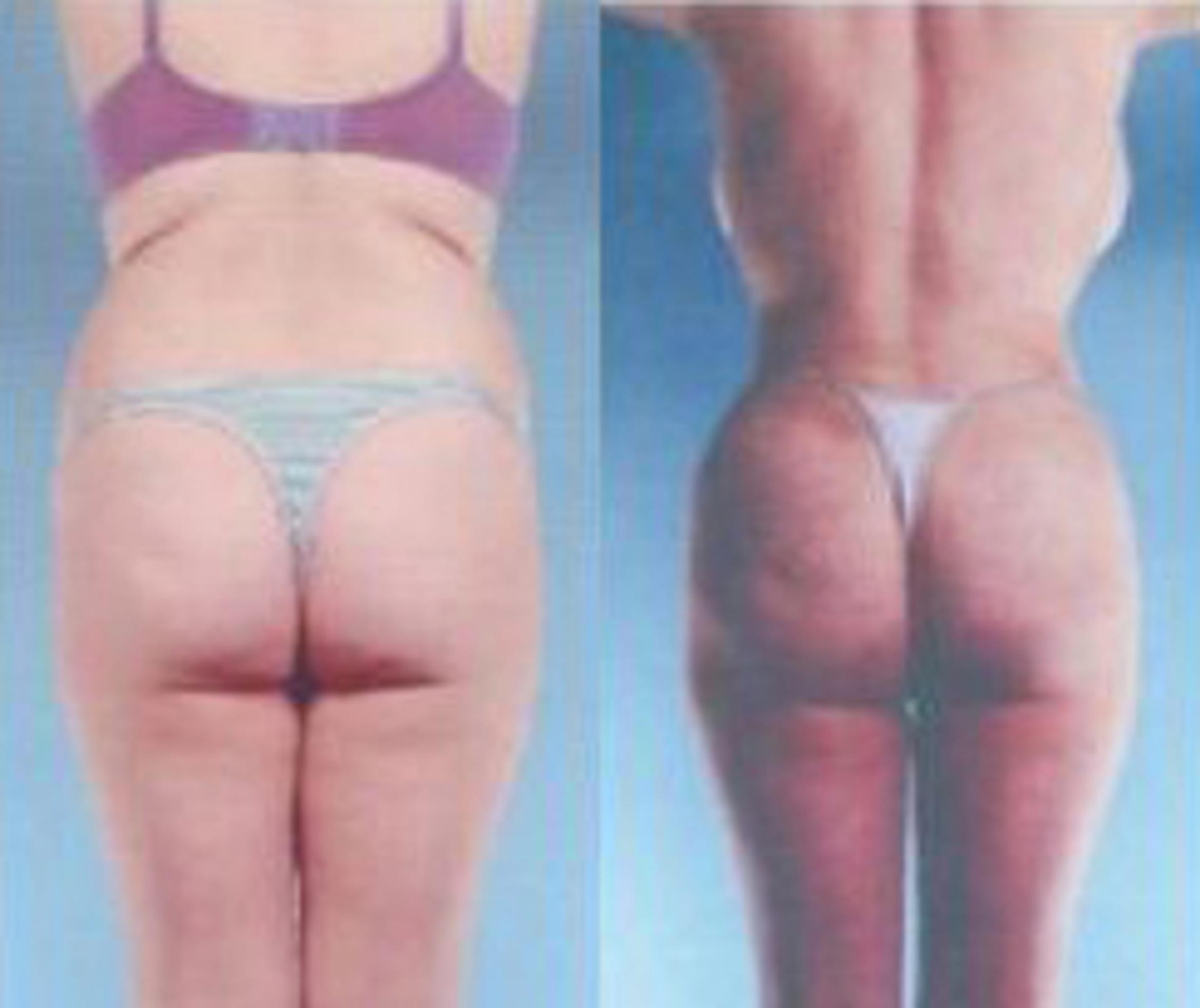 Before & After Liposuction Case 3671 View 3 View in Houston, TX