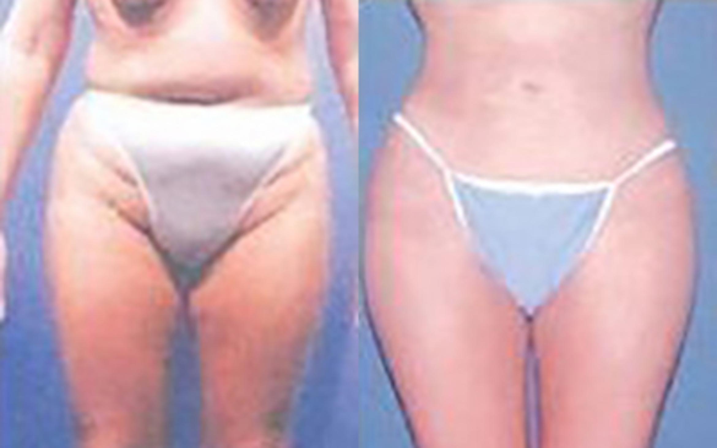 Before & After Liposuction Case 3679 View 1 View in Houston, TX