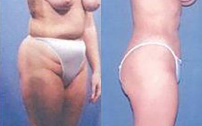 Before & After Liposuction Case 3679 View 2 View in Houston, TX