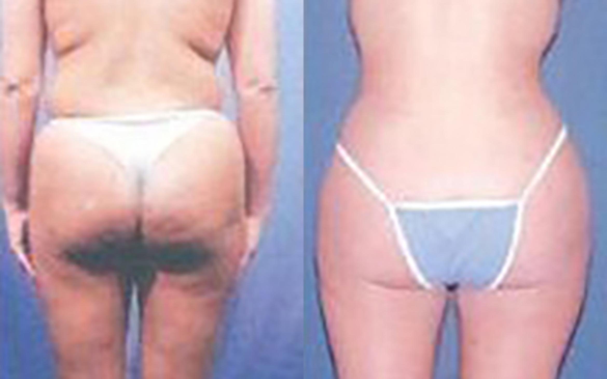 Before & After Liposuction Case 3679 View 3 View in Houston, TX