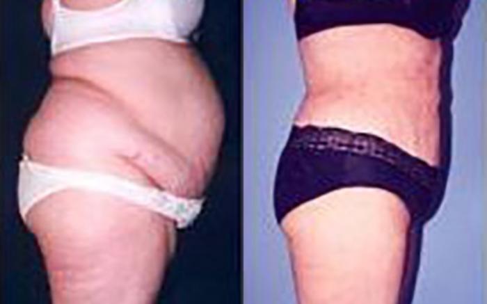 Before & After Liposuction Case 3687 View 1 View in Houston, TX