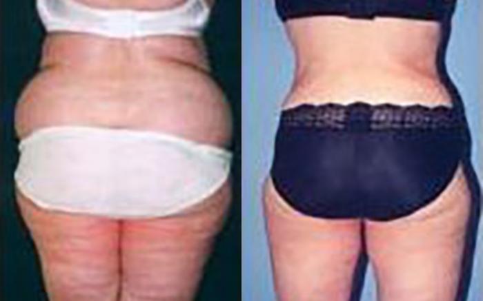 Before & After Liposuction Case 3687 View 2 View in Houston, TX