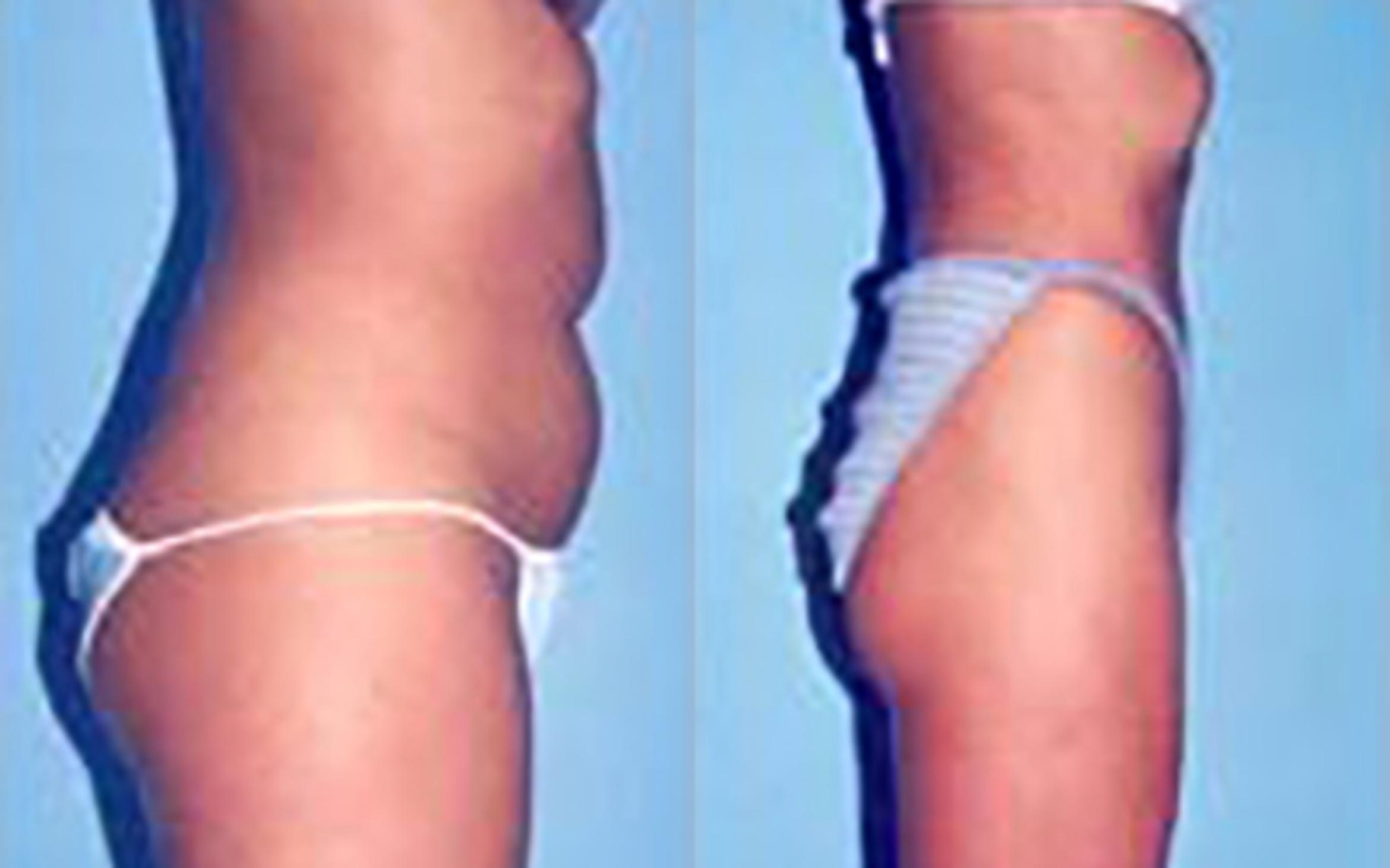 Before & After Liposuction Case 3693 View 1 View in Houston, TX