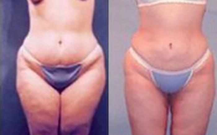 Before & After Liposuction Case 3697 View 1 View in Houston, TX