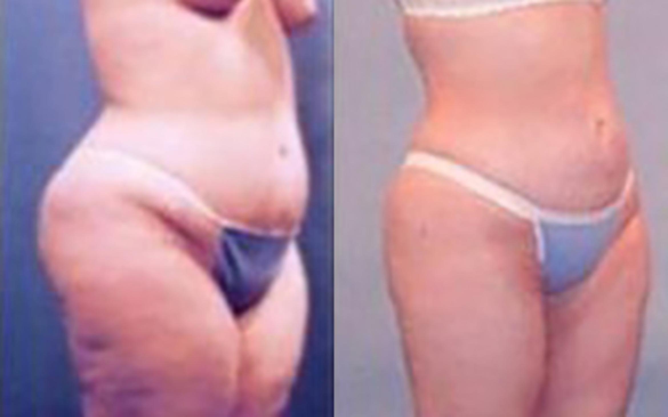 Before & After Liposuction Case 3697 View 2 View in Houston, TX