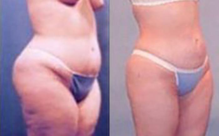 Before & After Liposuction Case 3697 View 2 View in Houston, TX