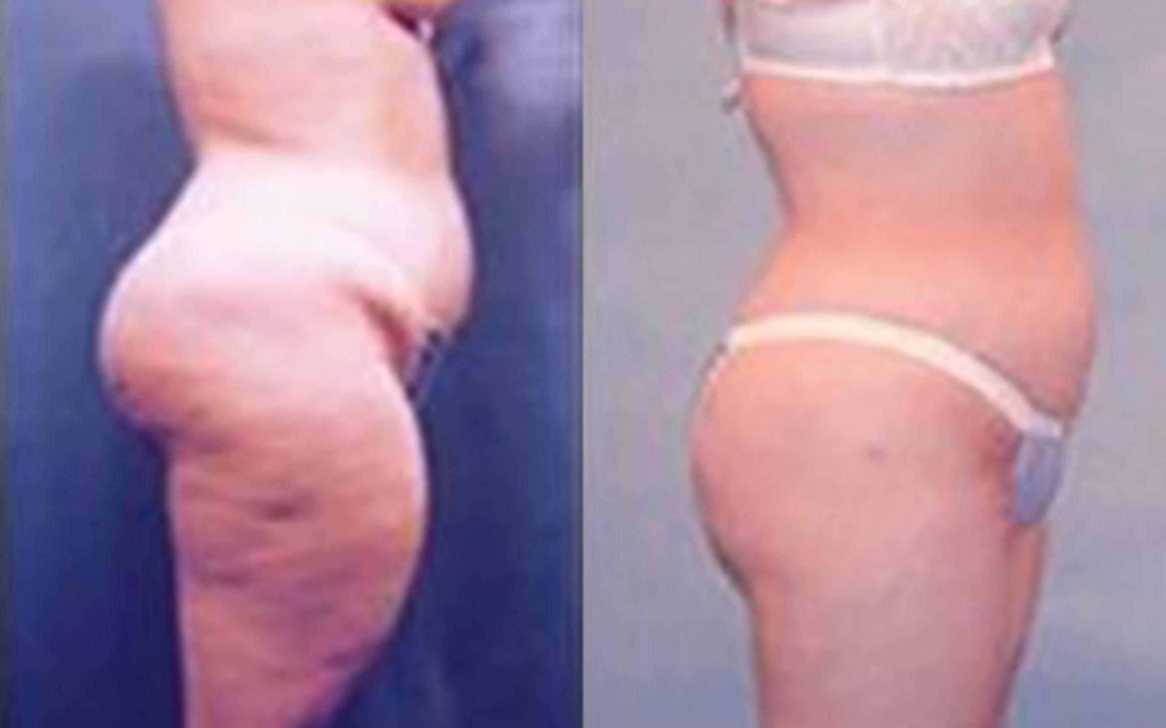 Before & After Liposuction Case 3697 View 3 View in Houston, TX