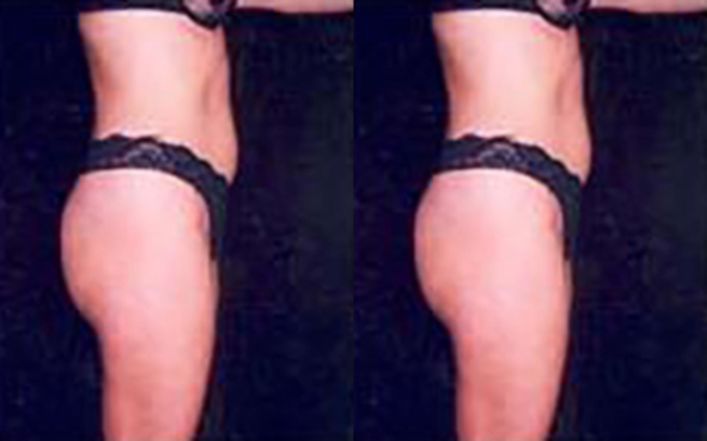 Before & After Liposuction Case 3705 View 1 View in Houston, TX