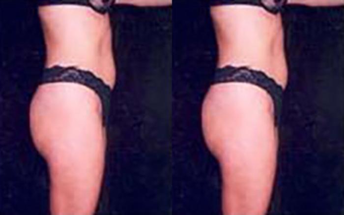 Before & After Liposuction Case 3705 View 1 View in Houston, TX