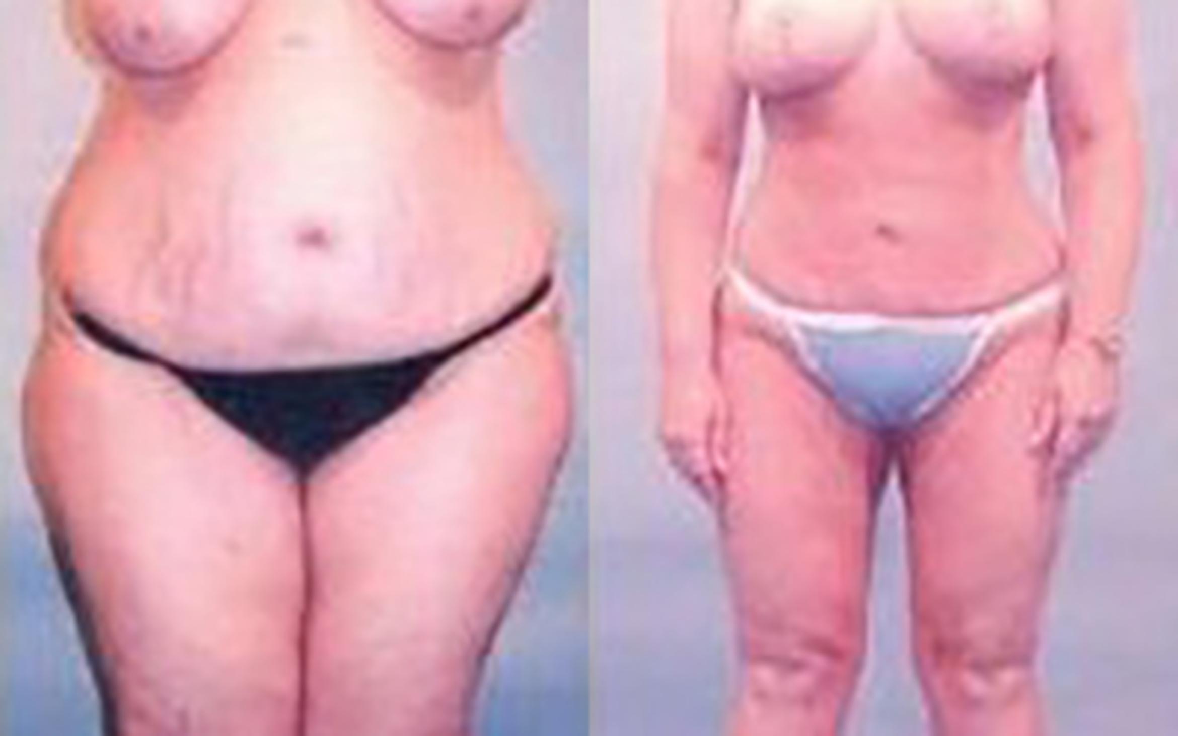 Before & After Liposuction Case 3709 View 1 View in Houston, TX