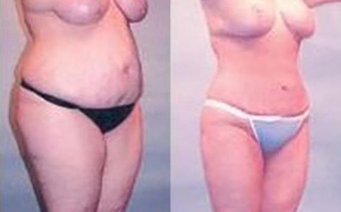 Before & After Liposuction Case 3709 View 2 View in Houston, TX