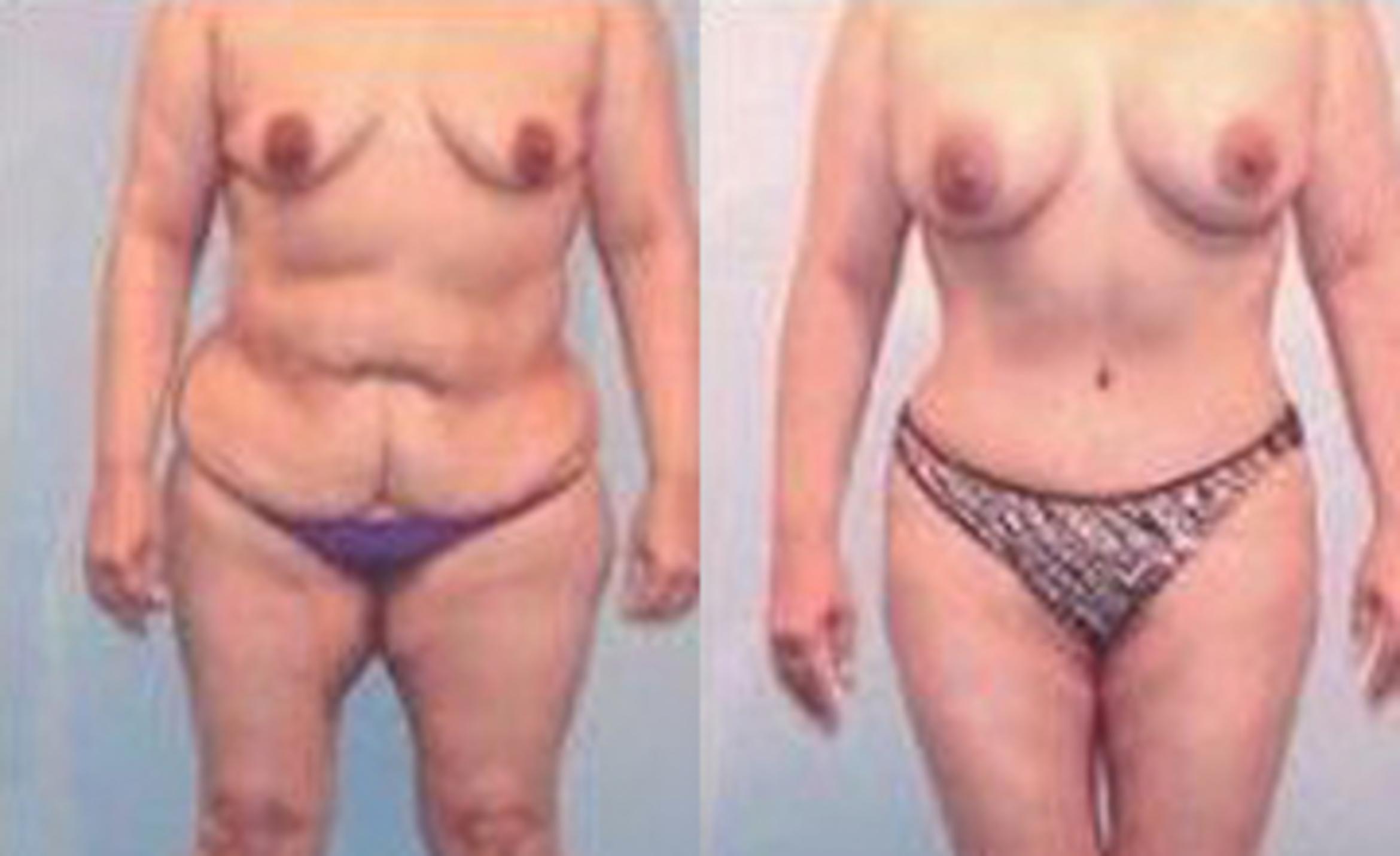 Before & After Liposuction Case 3715 View 1 View in Houston, TX