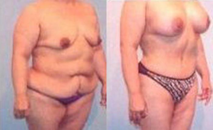 Before & After Liposuction Case 3715 View 2 View in Houston, TX