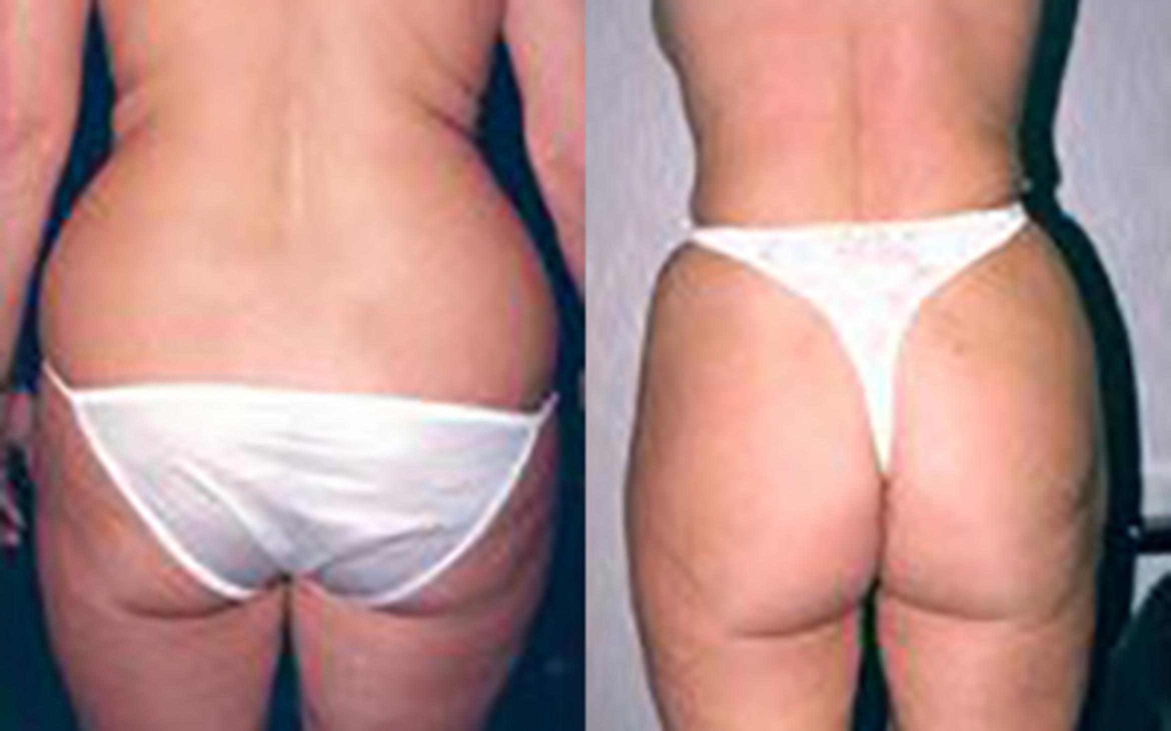 Before & After Liposuction Case 3721 View 1 View in Houston, TX