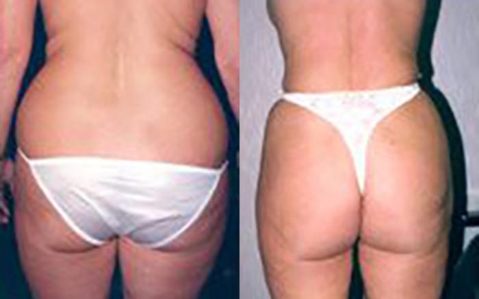 Before & After Liposuction Case 3721 View 1 View in Houston, TX