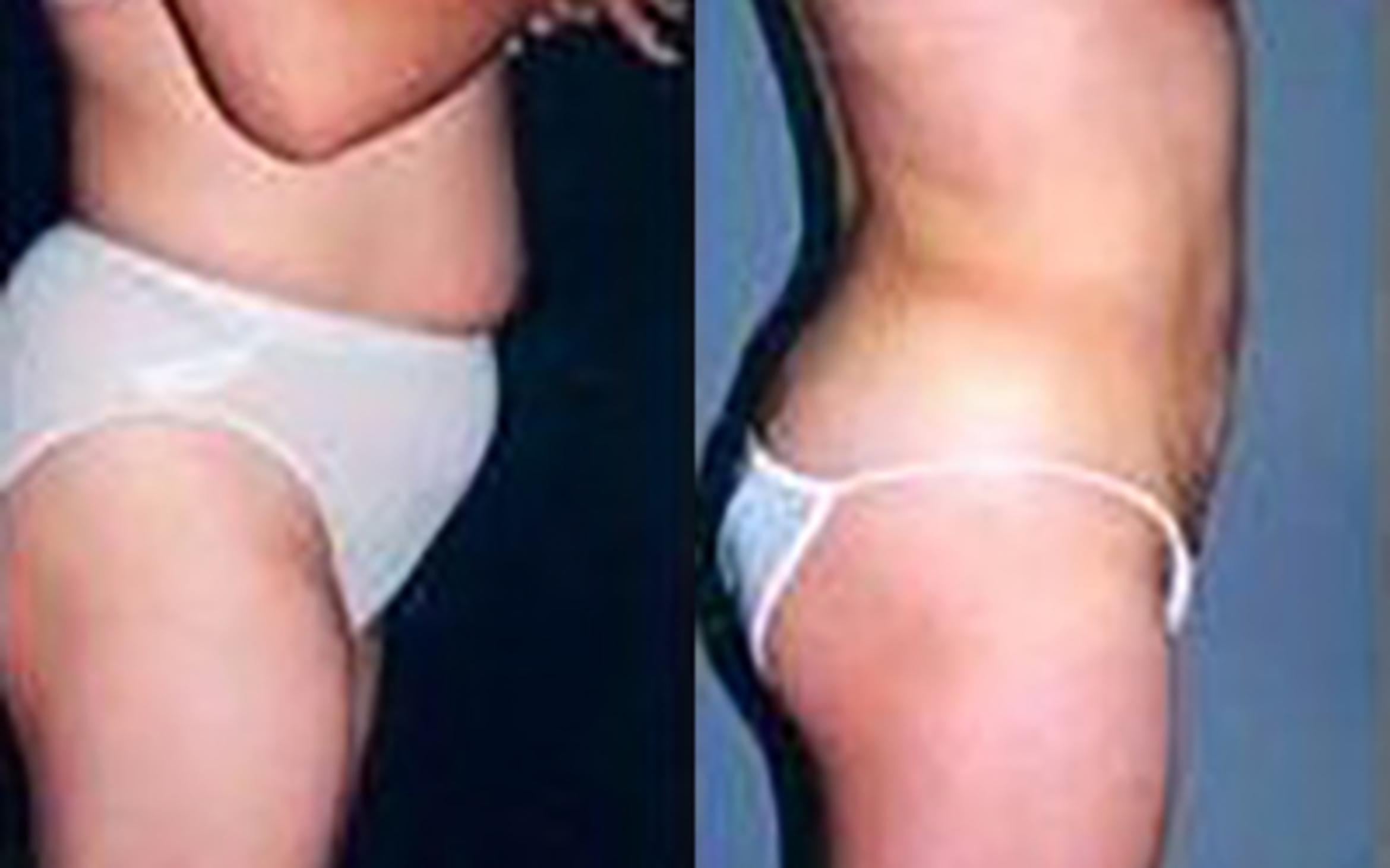 Before & After Liposuction Case 3725 View 1 View in Houston, TX