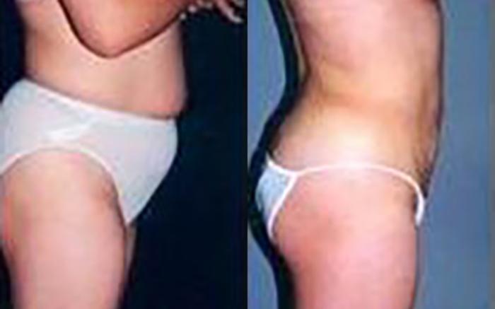 Before & After Liposuction Case 3725 View 1 View in Houston, TX