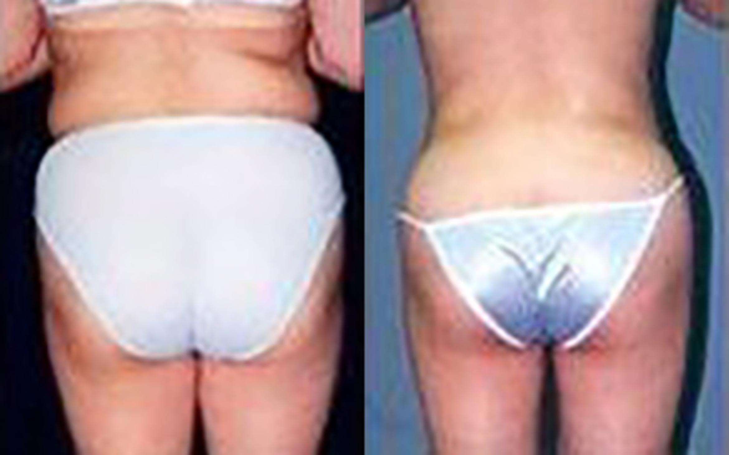 Before & After Liposuction Case 3725 View 2 View in Houston, TX