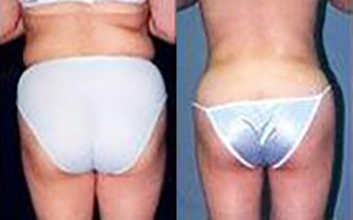 Before & After Liposuction Case 3725 View 2 View in Houston, TX
