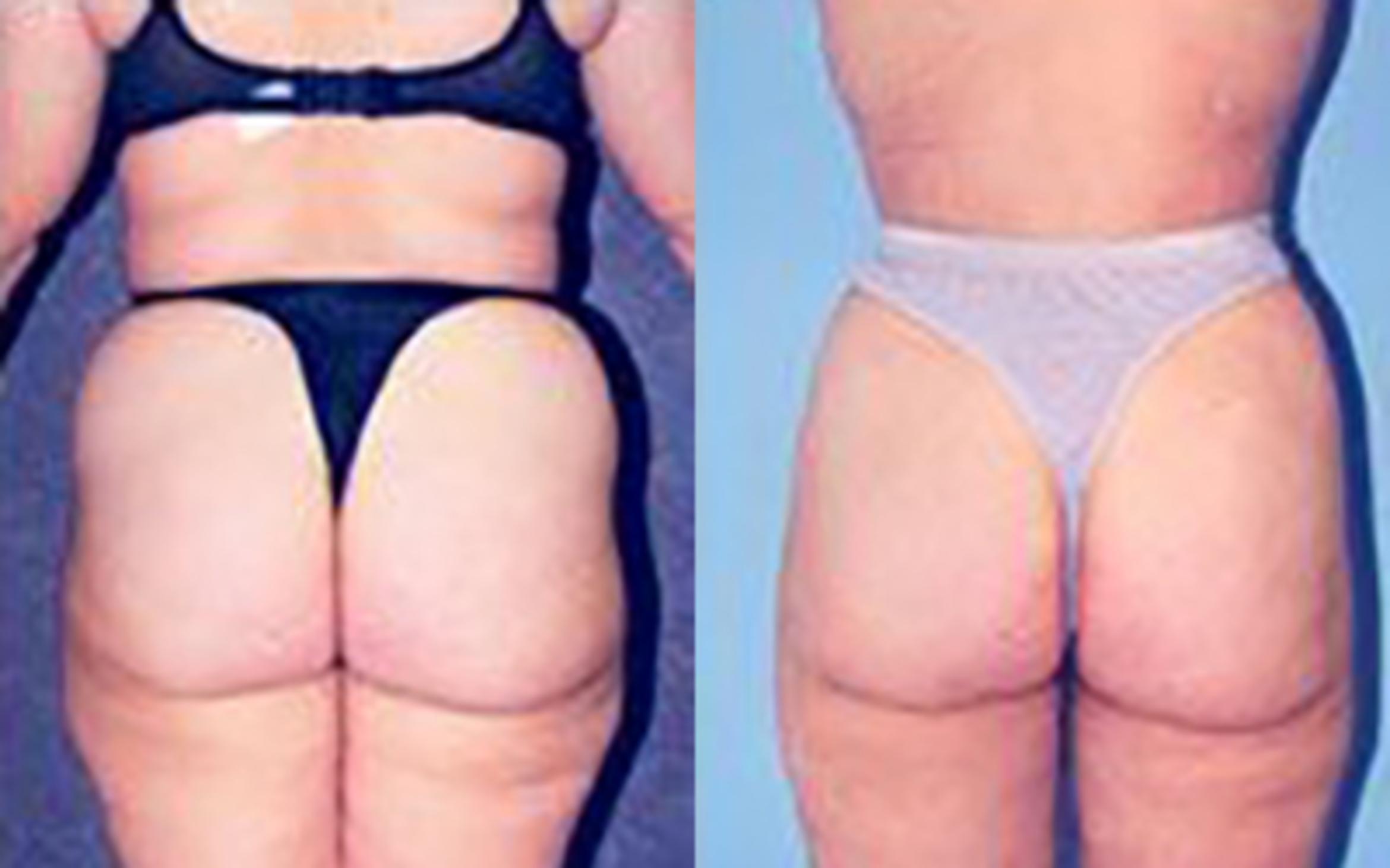 Before & After Liposuction Case 3731 View 1 View in Houston, TX