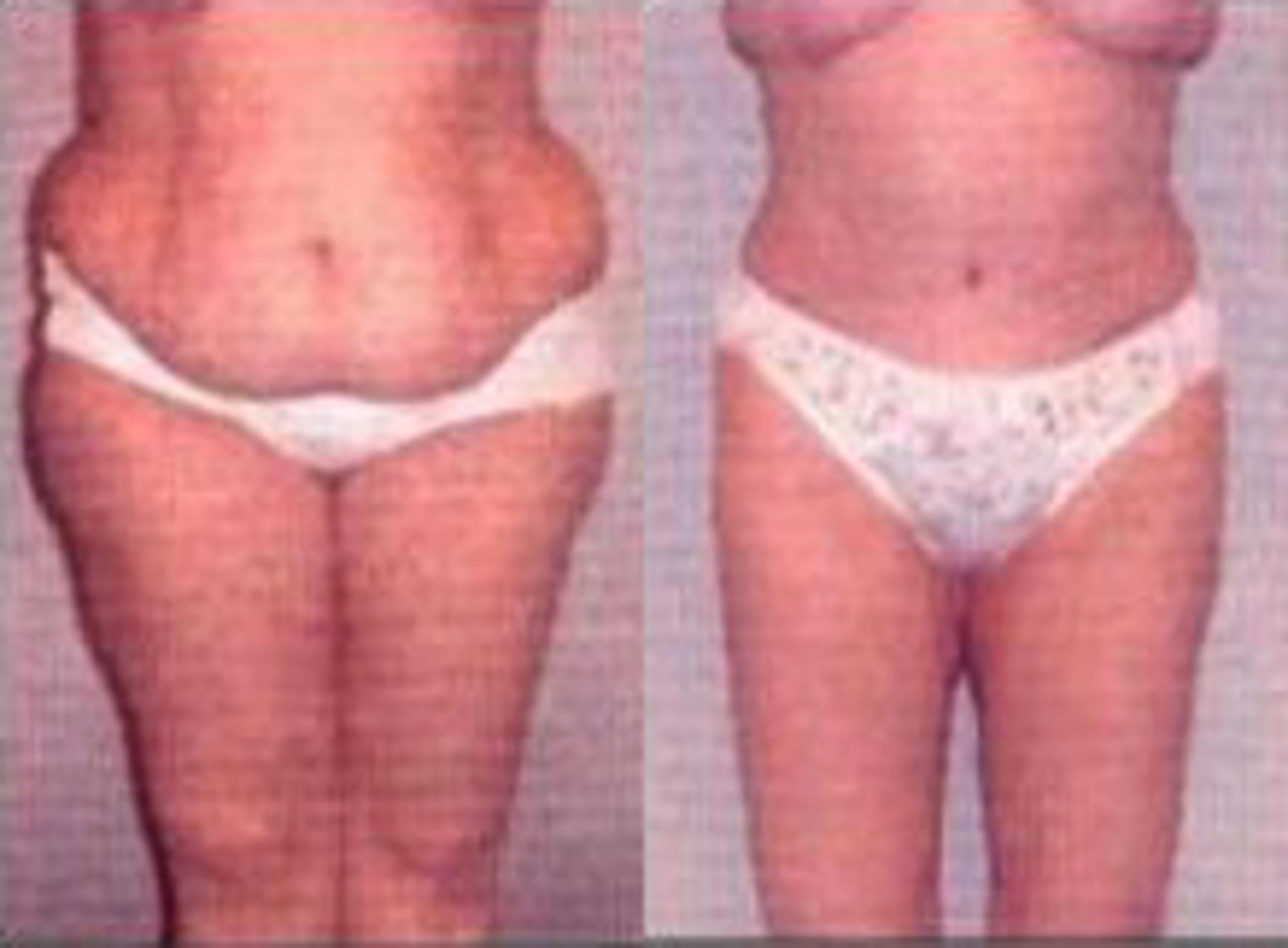 Before & After Liposuction Case 3735 View 1 View in Houston, TX